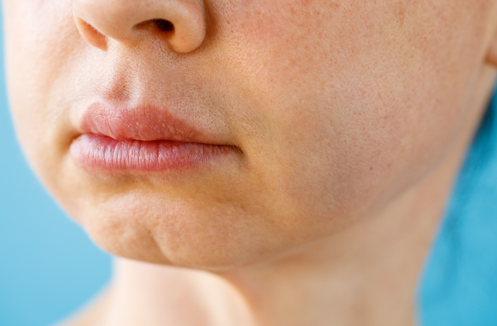 A person with swollen cheeks as a result of wisdom teeth removal surgery