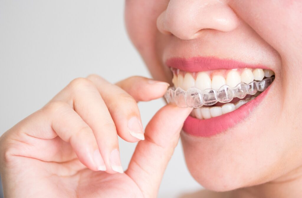 A close up of a person inserting an Invisalign clear aligner into their mouth.